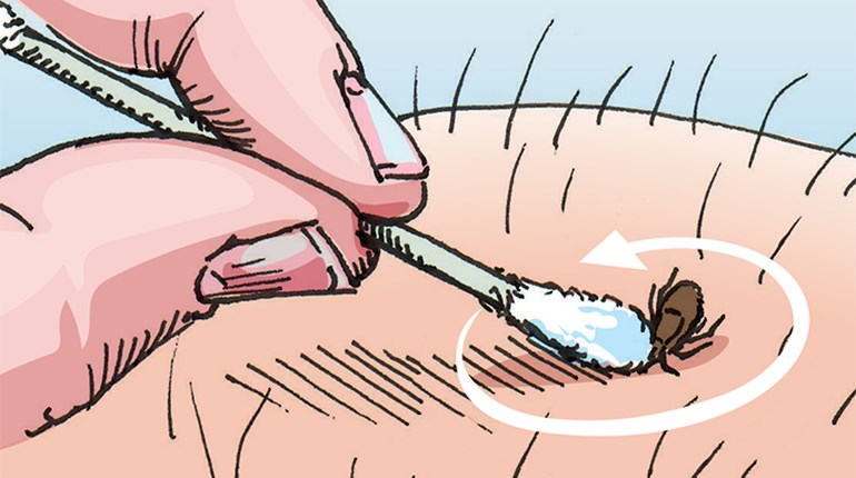 A Simple, Safe Way to Remove Ticks | An Official Journal Of The NRA